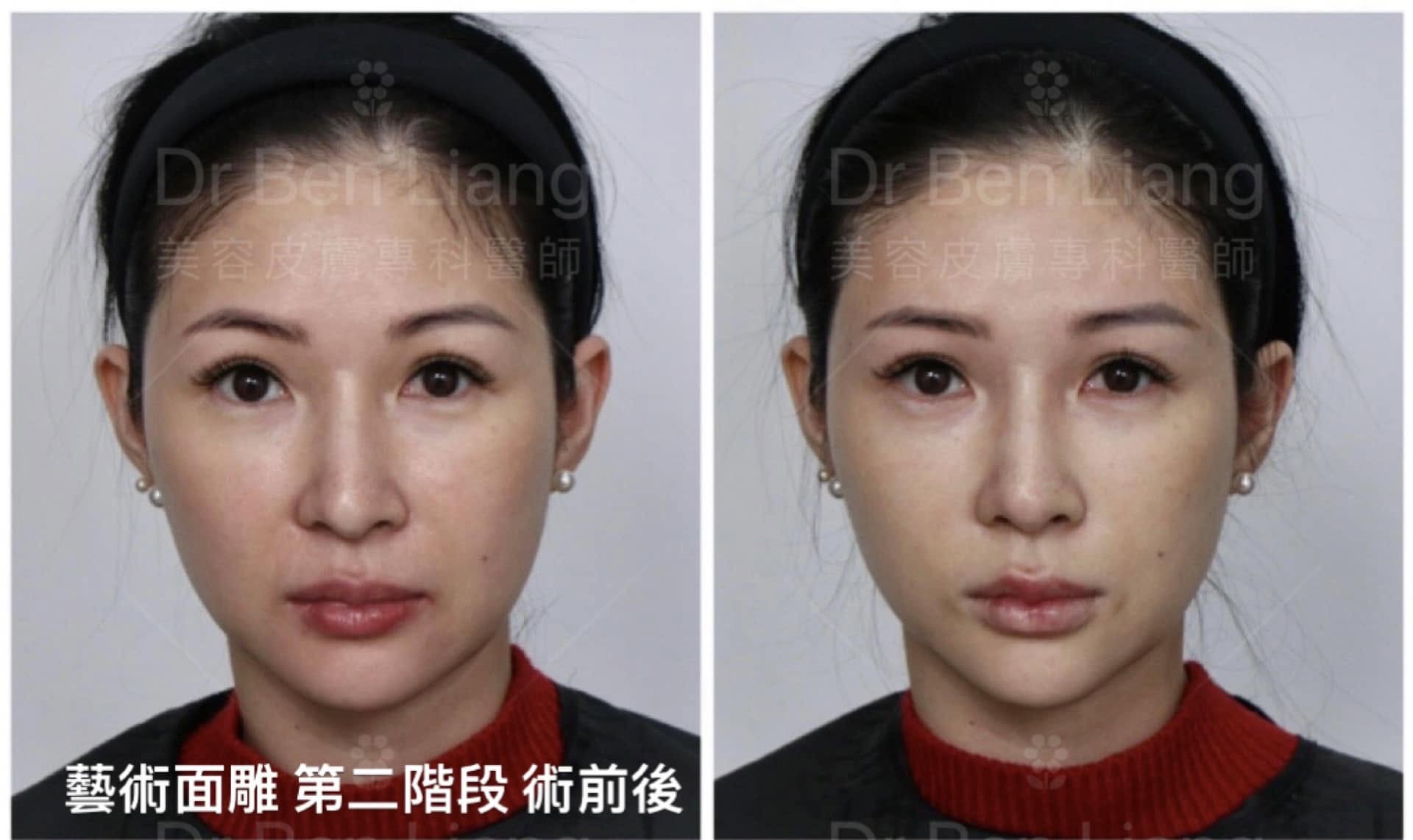 藝術面雕 Plus 第二階段術前後比較